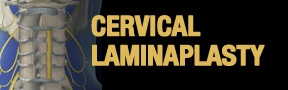 Cervical-Laminaplasty