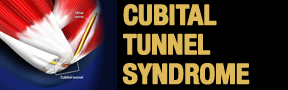 Cubital-Tunnel-Syndrome