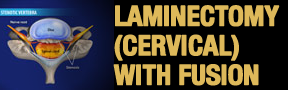 Laminectomy-Cervical-W-FUS