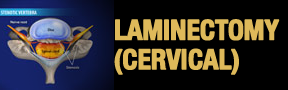 Laminectomy-Cervical