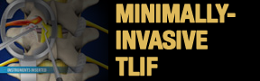 Minimally-Invasive-TLIF