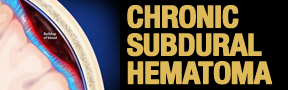 Chronic-Subdural-Hematoma-button