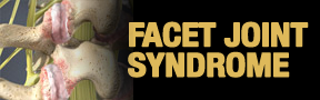 Facet-Joint-Syndrome