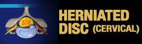 Herniated-Disc-cervical