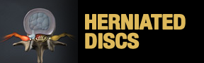 Herniated-Disc