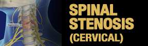 Spinal-Stenosis-cervical