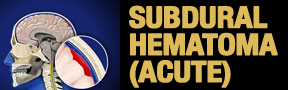 Subdural-Hematoma-button